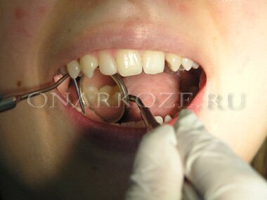 осмотр стоматологом рта