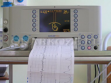 Регистрация кардиотокограммы